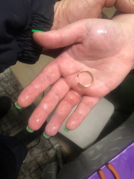 В Тетерино спасатели освободили палец женщины от кольца